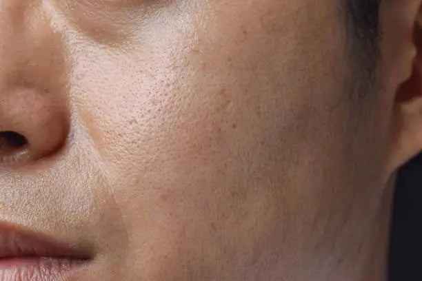 Oily-Skin-Control Derma.pk