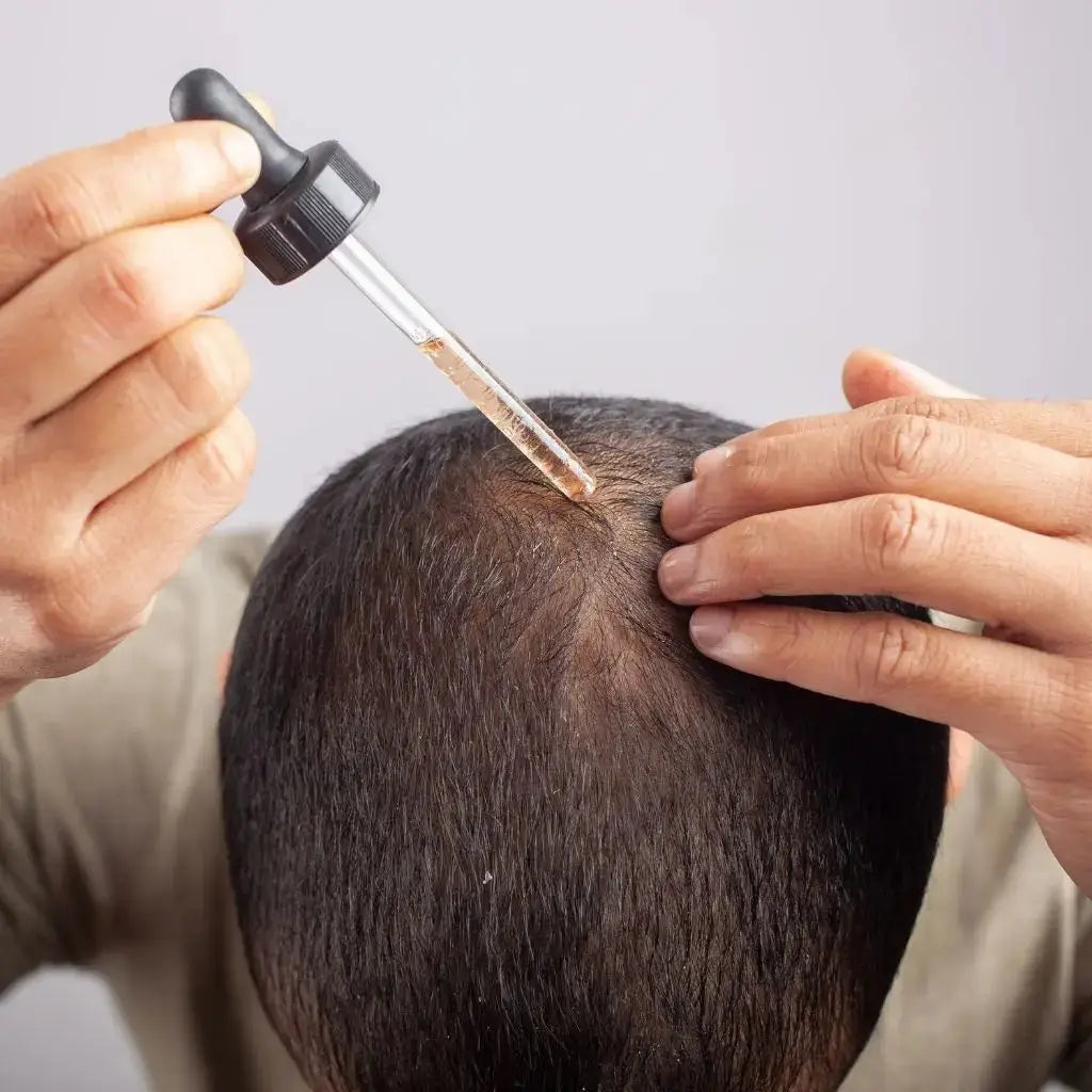 Minoxidil for hair regrowth in Pakistan | Derma.pk
