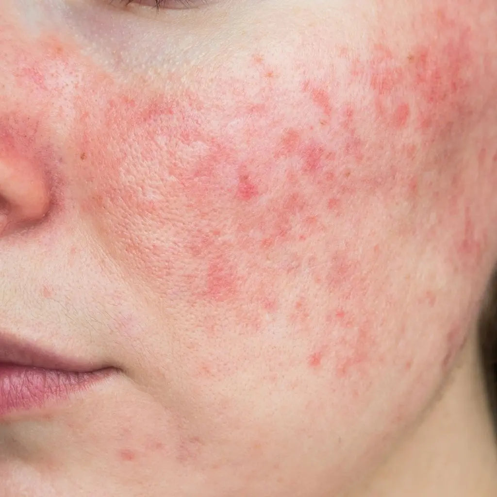 Rosacea Derma.pk