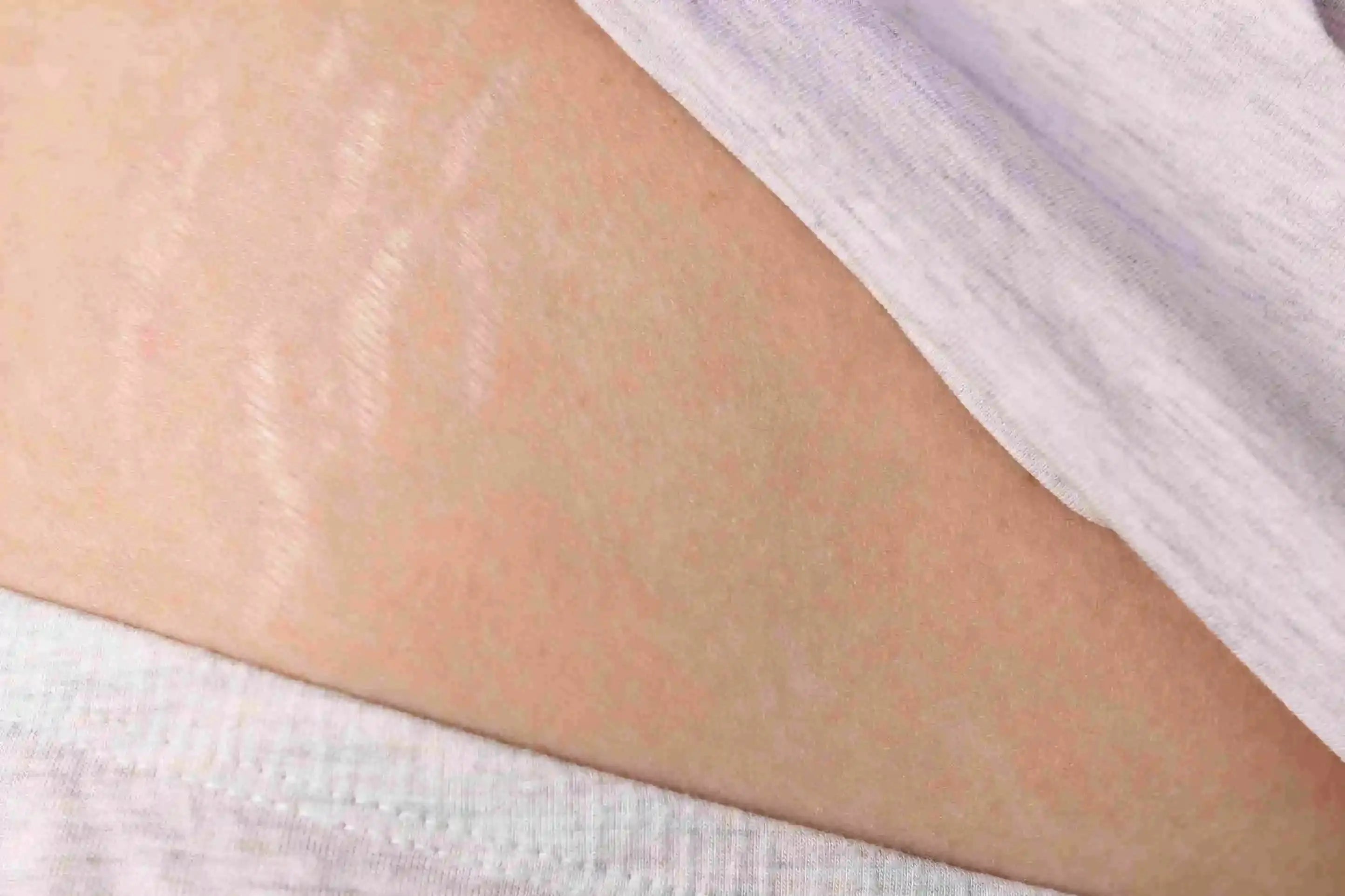 Stretch Mark
