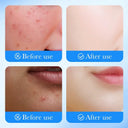 SADOER Acne Patch - Hydrocolloid & Star+Round - Invisible Protection photo 4