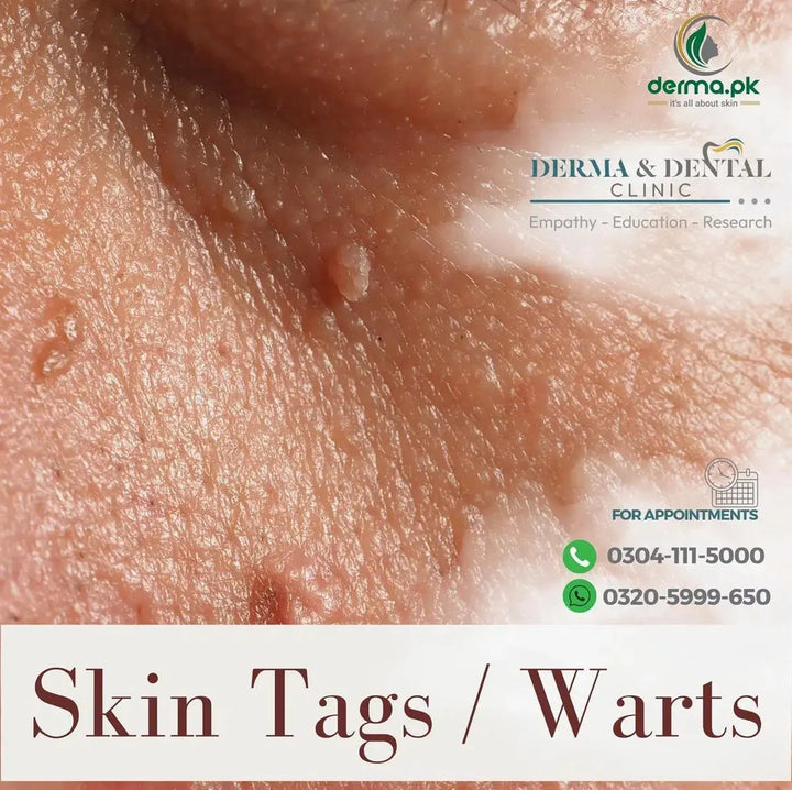Advanced Dermatology Solutions: Expert Skin Tag and Wart Treatments Derma.pk