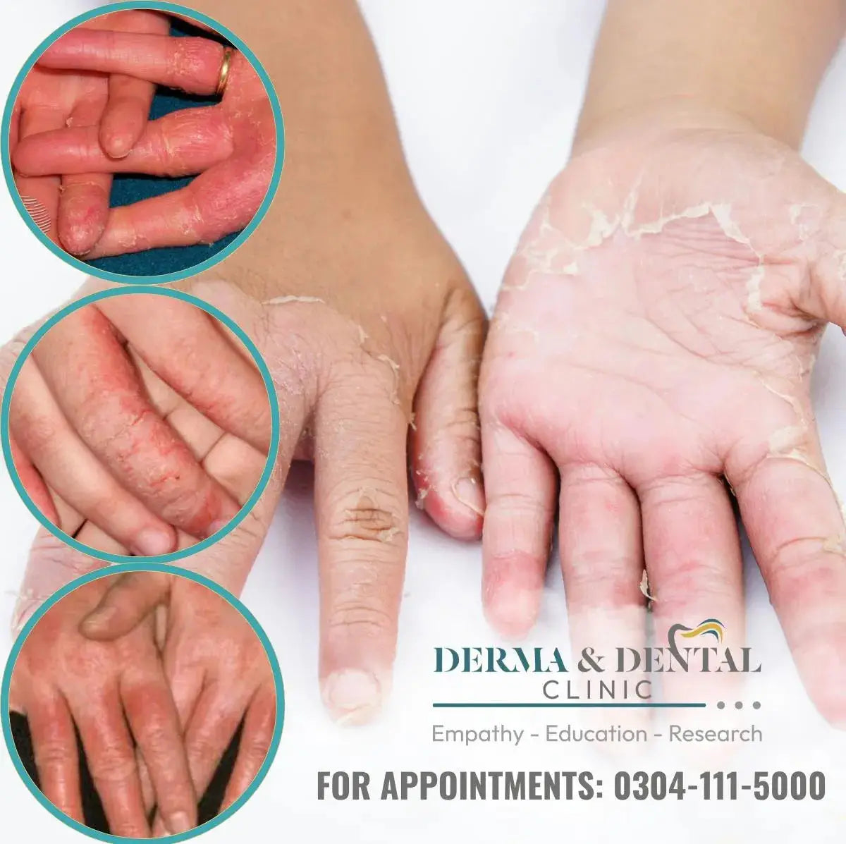 Hand Derma Discover Your Path to Healthy, Beautiful Hands: Hand Eczema Treatment ...