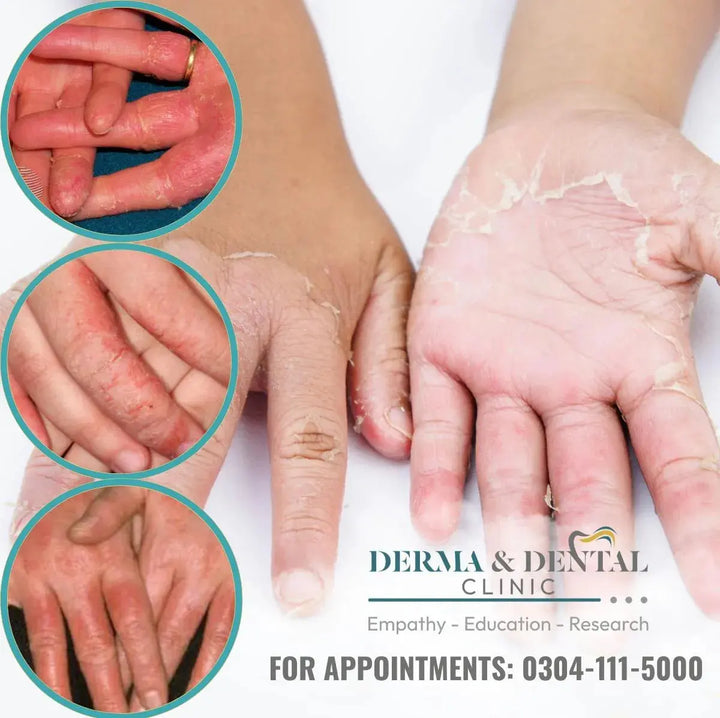 contact eczema