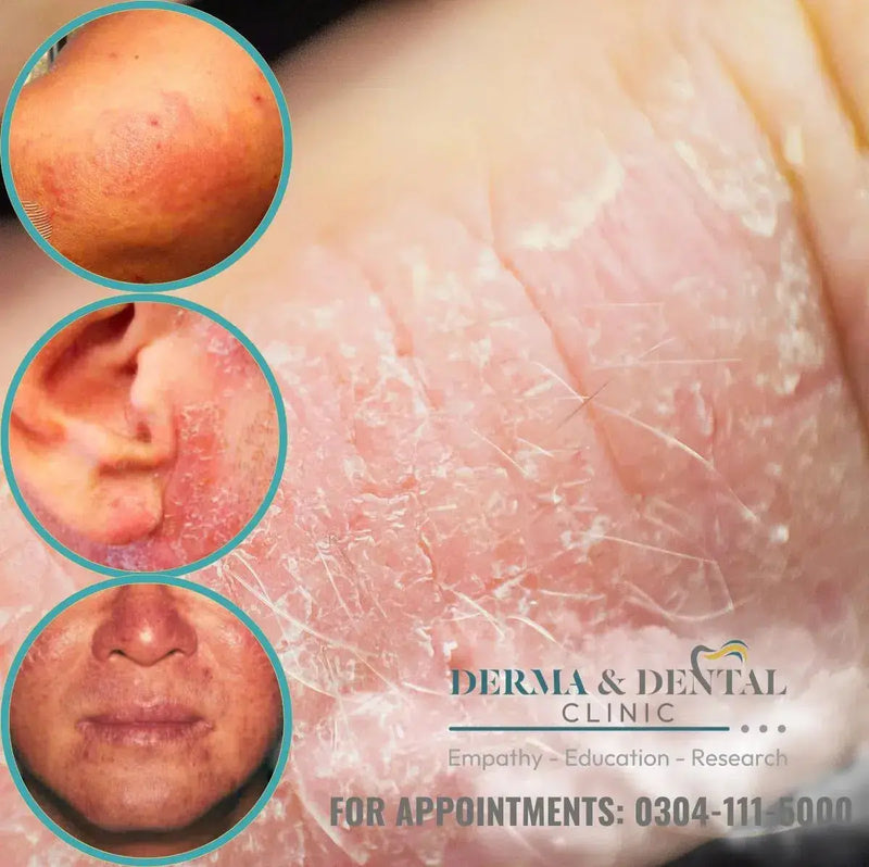 Experience Relief from Photocontact Eczema at Skin Clinic by Dr. Eram Razzaq