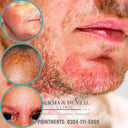Expert Care for Seborrheic Eczema at Skin Clinic by Dr. Eram Razzaq photo 1