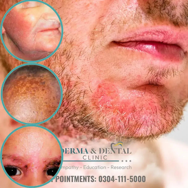 Expert Care for Seborrheic Eczema at Derma & Dental Clinic Derma.pk
