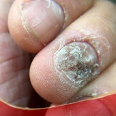 Fungal Relief & Itch