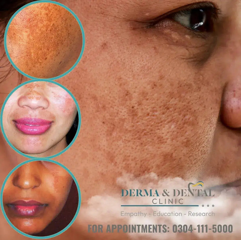 Melasma Unmasked: Discover Clearer Skin with Skin Clinic by Dr. Eram Razzaq