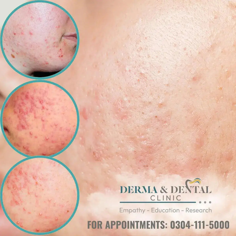 Conquer Nodulocystic Acne with Skin Clinic by Dr. Eram Razzaq: Your Path to Clear, Healthy Skin