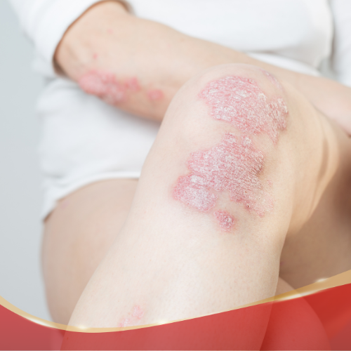 Psoriasis