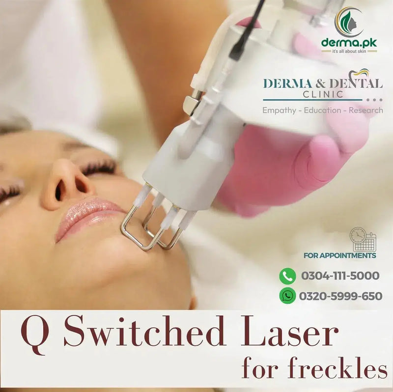 The Science of Flawless Skin: QSwitched Laser Treatment for Freckles at Skin Clinic by Dr. Eram Razzaq