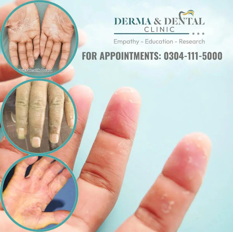 Pompholyx (Dyshidrotic Eczema) Treatment in Lahore