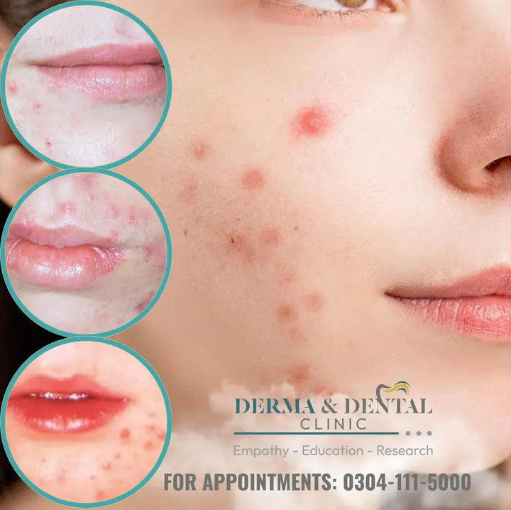 Unlock Flawless Skin: Your Guide to Acne Solutions at Derma & Dental Clinic Derma.pk