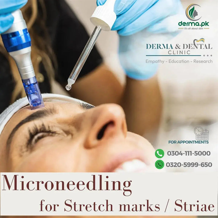 Microneedling for Stretch Marks at Derma & Dental Clinic Derma.pk