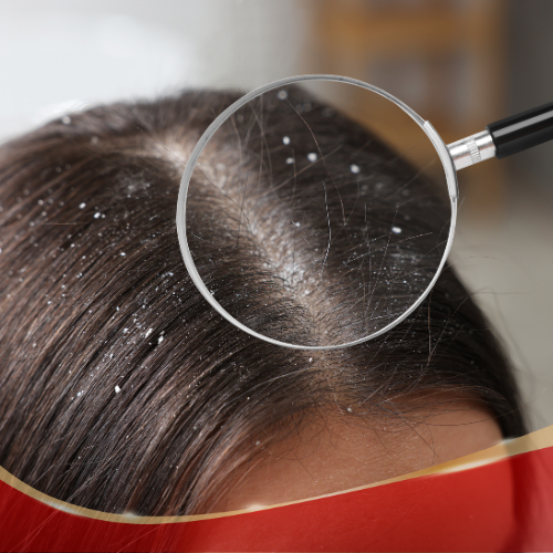 Anti Dandruff