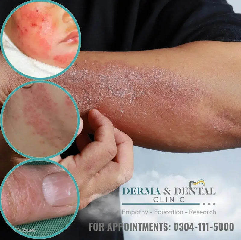 Atopic Eczema Treatment in Lahore | Derma.pk