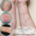 Contact Eczema Treatment in Lahore | Derma.pk photo 1