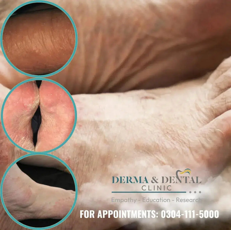Suffering from Shoe Contact Eczema? Find Relief at Skin Clinic by Dr. Eram Razzaq Bahria Town Lahore