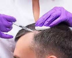 Microneedling with PRP for Scalp - Skin Clinic by Dr. Eram Razzaq