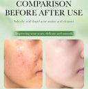 SADOER Salicylic Acid Anti-Acne Oil Control Facial Cleanser  - 100g photo 5