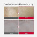 Medicube Red Acne Body Peeling Shot 110g photo 3